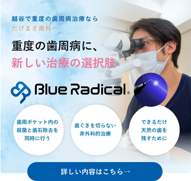 歯周病治療/ブルーラジカル